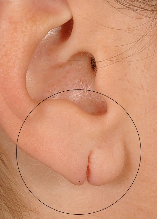 Earlobe Repair - The Complete Awesome Guide with Tips and Treatments -  Kalpana Aesthetics